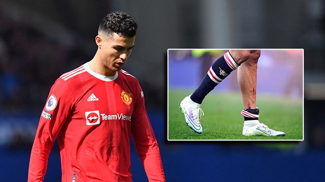 Deux trous et des bleus- les jambes de Cristiano Ronaldo sont dans un sale état après la défaite de son équipe (photos)