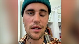 Justin Bieber paralysé de la moitié du visage- il est atteint d'un syndrome rare